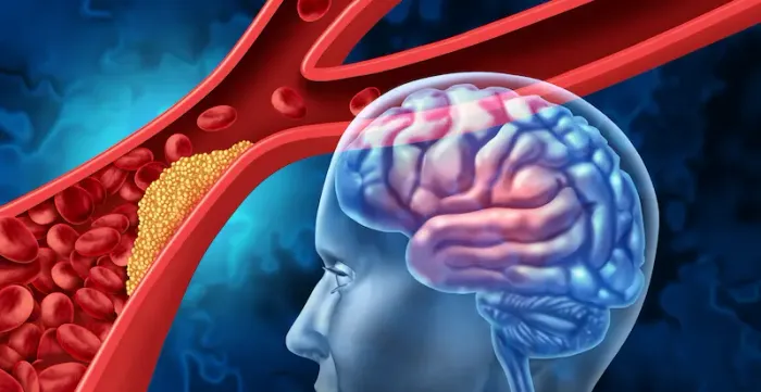 Brain Aneurysm Symptoms, Causes, and Treatment
